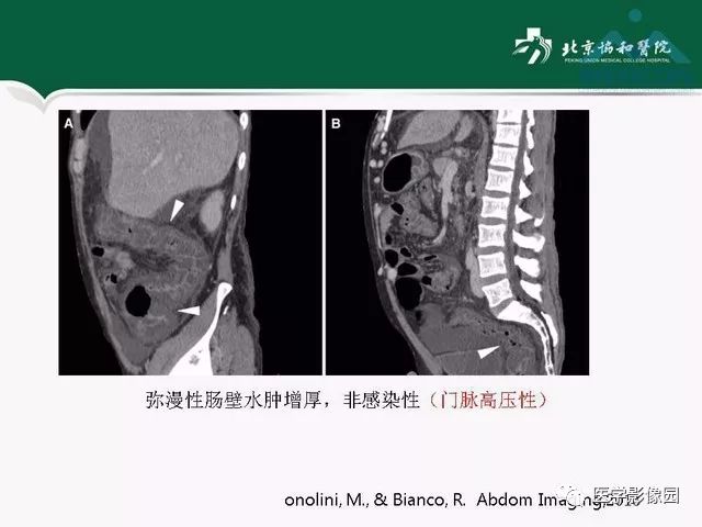 【PPT】艾滋病相关消化道影像学表现