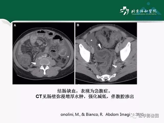 【PPT】艾滋病相关消化道影像学表现