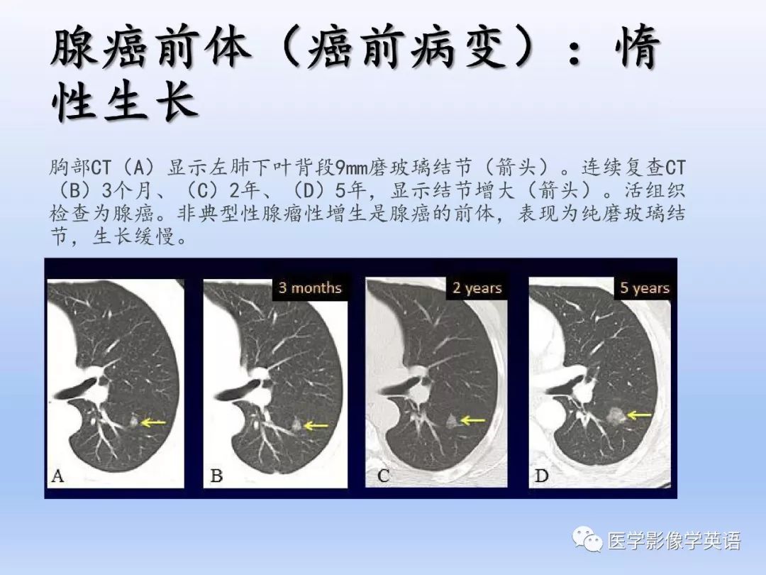 【PPT】第八版肺腺癌TNM分期影像学解读 【PPT】第八版肺腺癌TNM分期影像学解读