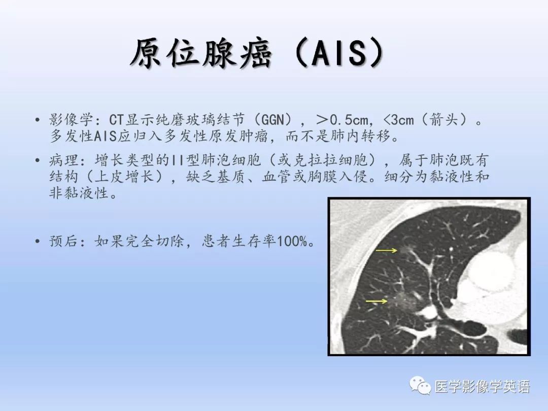 【PPT】第八版肺腺癌TNM分期影像学解读 【PPT】第八版肺腺癌TNM分期影像学解读