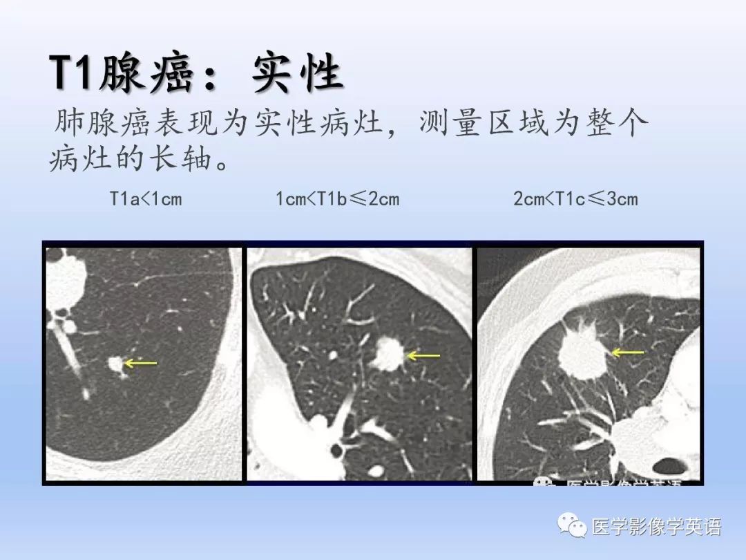 【PPT】第八版肺腺癌TNM分期影像学解读 【PPT】第八版肺腺癌TNM分期影像学解读
