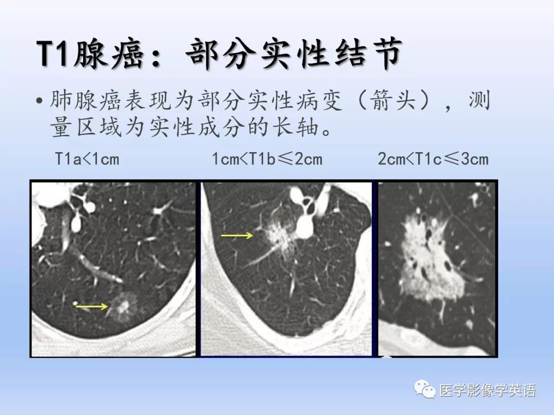 【PPT】第八版肺腺癌TNM分期影像学解读 【PPT】第八版肺腺癌TNM分期影像学解读