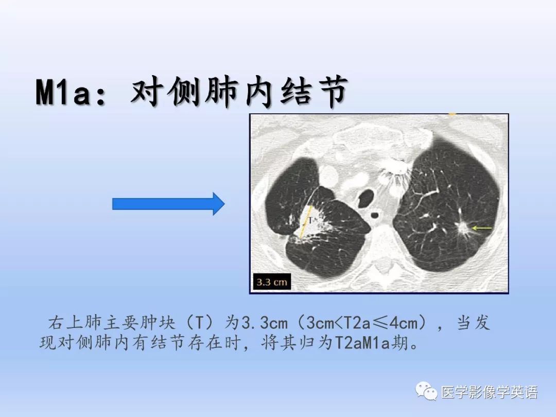 【PPT】第八版肺腺癌TNM分期影像学解读 【PPT】第八版肺腺癌TNM分期影像学解读