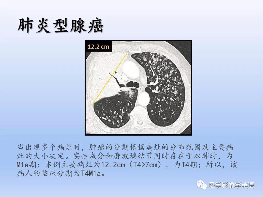 【PPT】第八版肺腺癌TNM分期影像学解读 【PPT】第八版肺腺癌TNM分期影像学解读