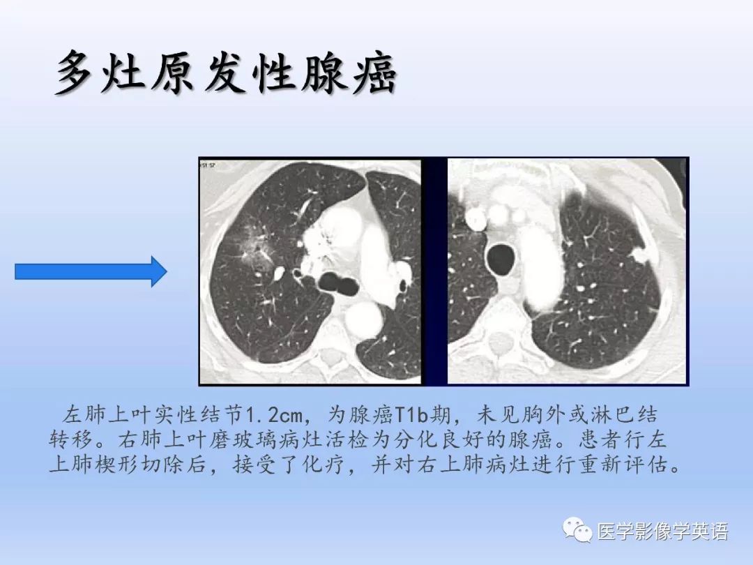 【PPT】第八版肺腺癌TNM分期影像学解读 【PPT】第八版肺腺癌TNM分期影像学解读