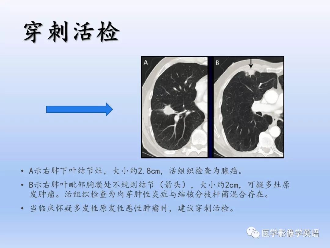 【PPT】第八版肺腺癌TNM分期影像学解读 【PPT】第八版肺腺癌TNM分期影像学解读