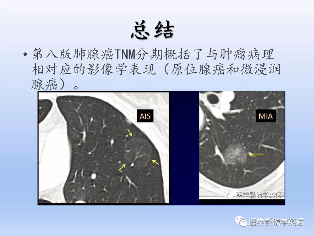 【PPT】第八版肺腺癌TNM分期影像学解读 【PPT】第八版肺腺癌TNM分期影像学解读