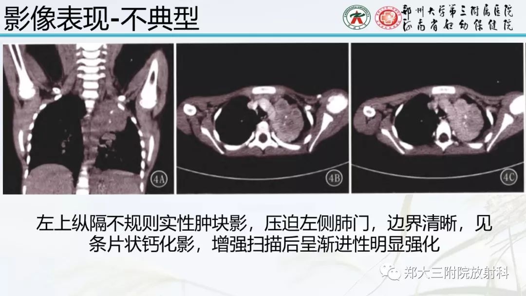 【PPT】炎性肌纤维母细胞瘤的影像表现
