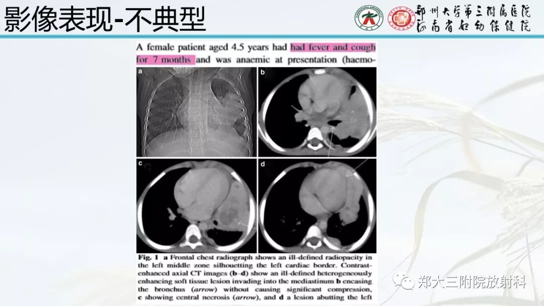 【PPT】炎性肌纤维母细胞瘤的影像表现