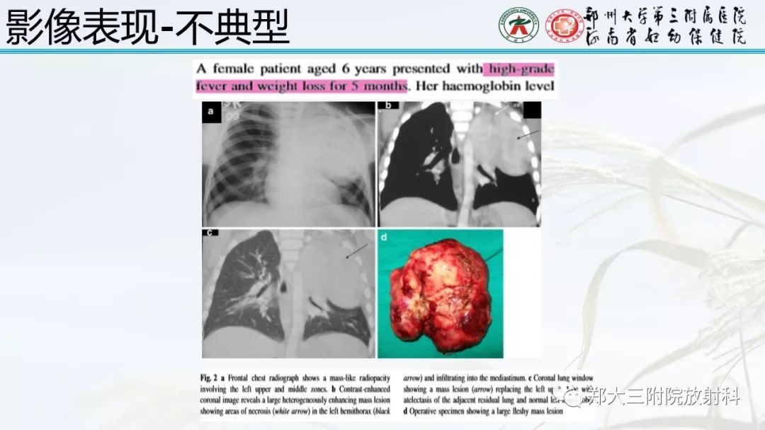 【PPT】炎性肌纤维母细胞瘤的影像表现