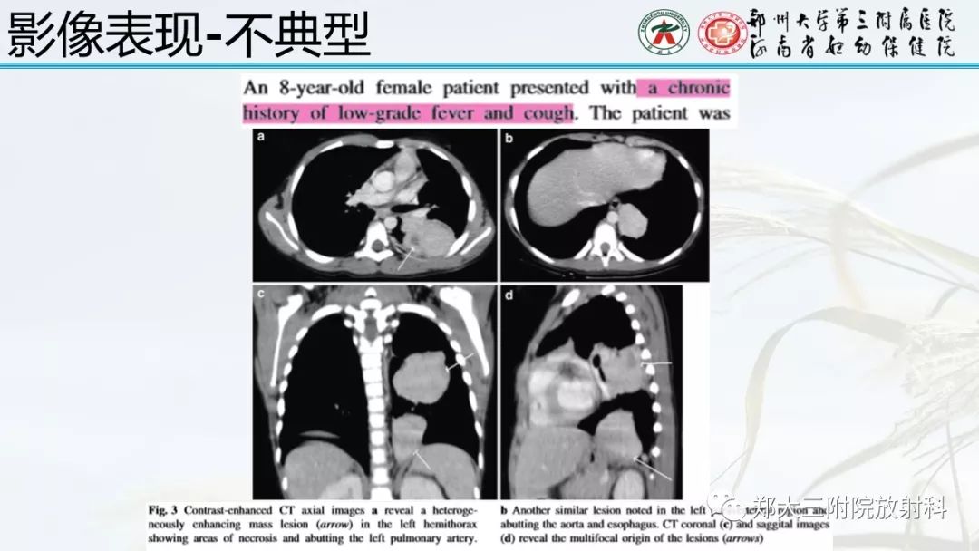 【PPT】炎性肌纤维母细胞瘤的影像表现