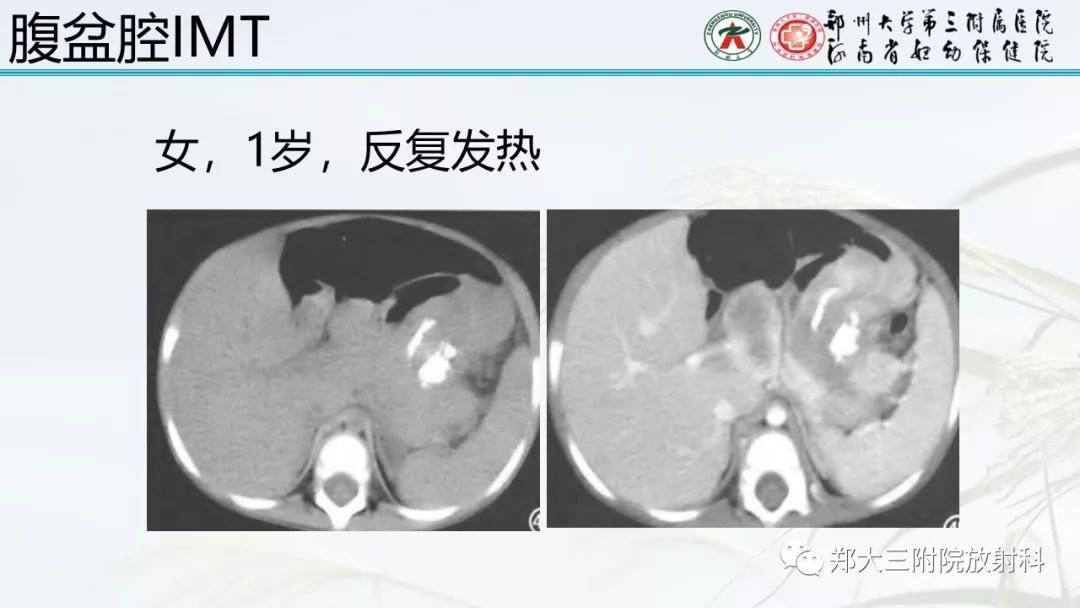 【PPT】炎性肌纤维母细胞瘤的影像表现