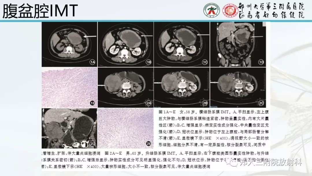 【PPT】炎性肌纤维母细胞瘤的影像表现