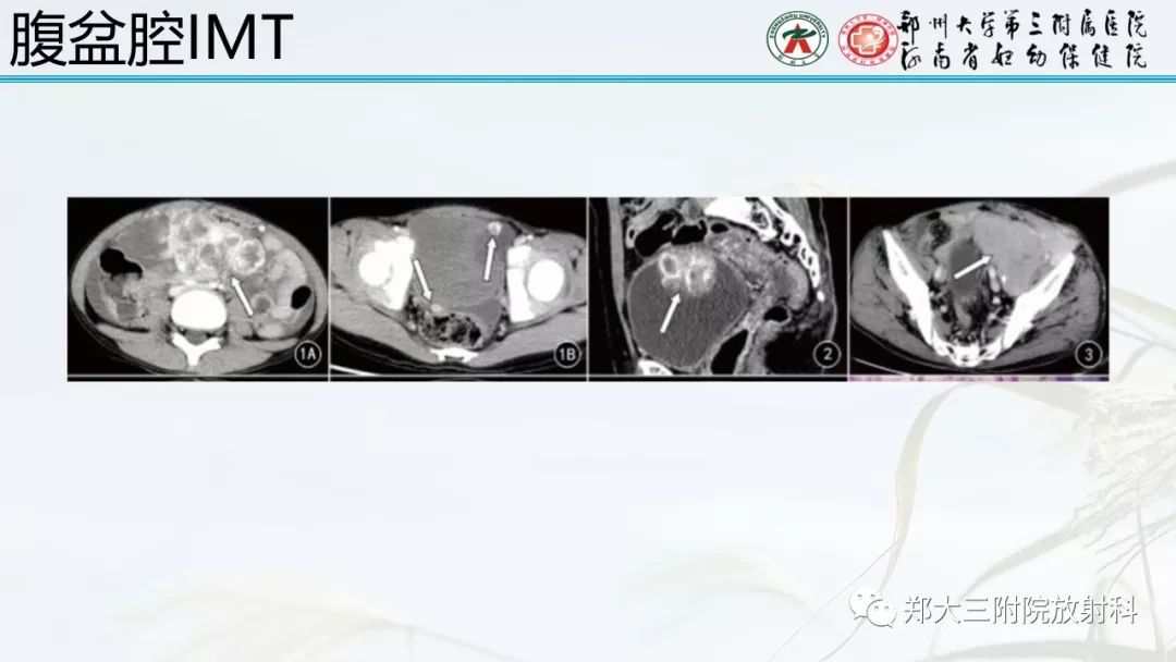 【PPT】炎性肌纤维母细胞瘤的影像表现