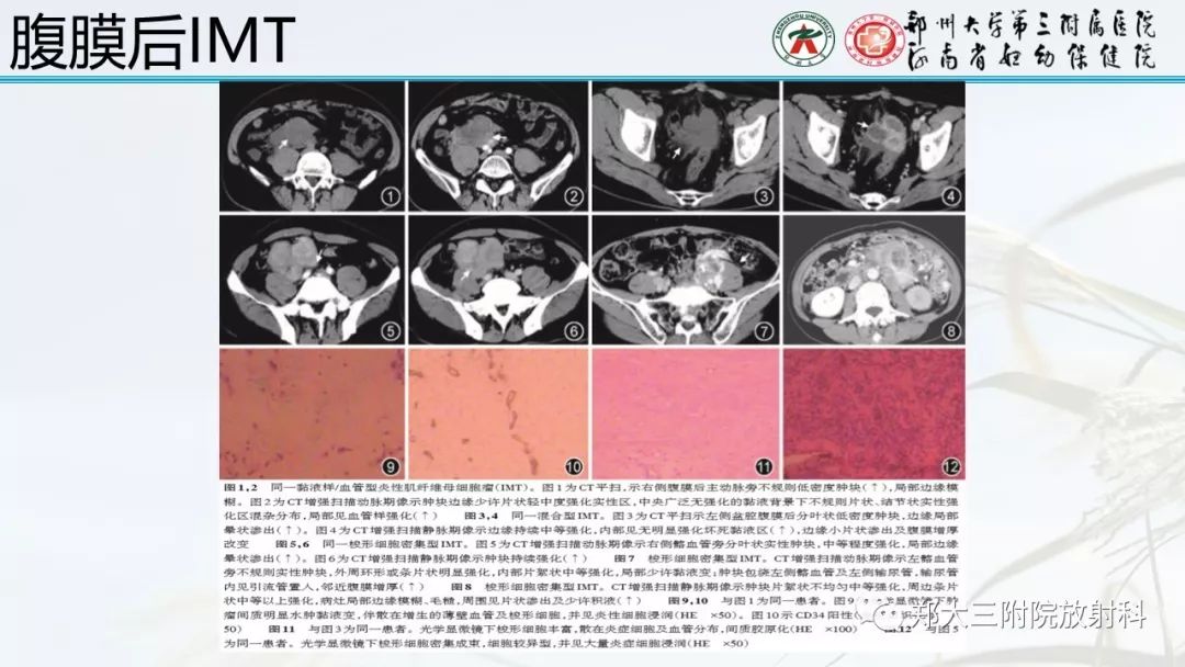 【PPT】炎性肌纤维母细胞瘤的影像表现