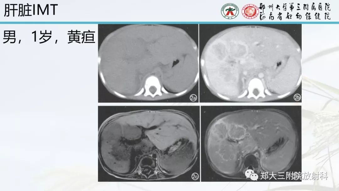 【PPT】炎性肌纤维母细胞瘤的影像表现