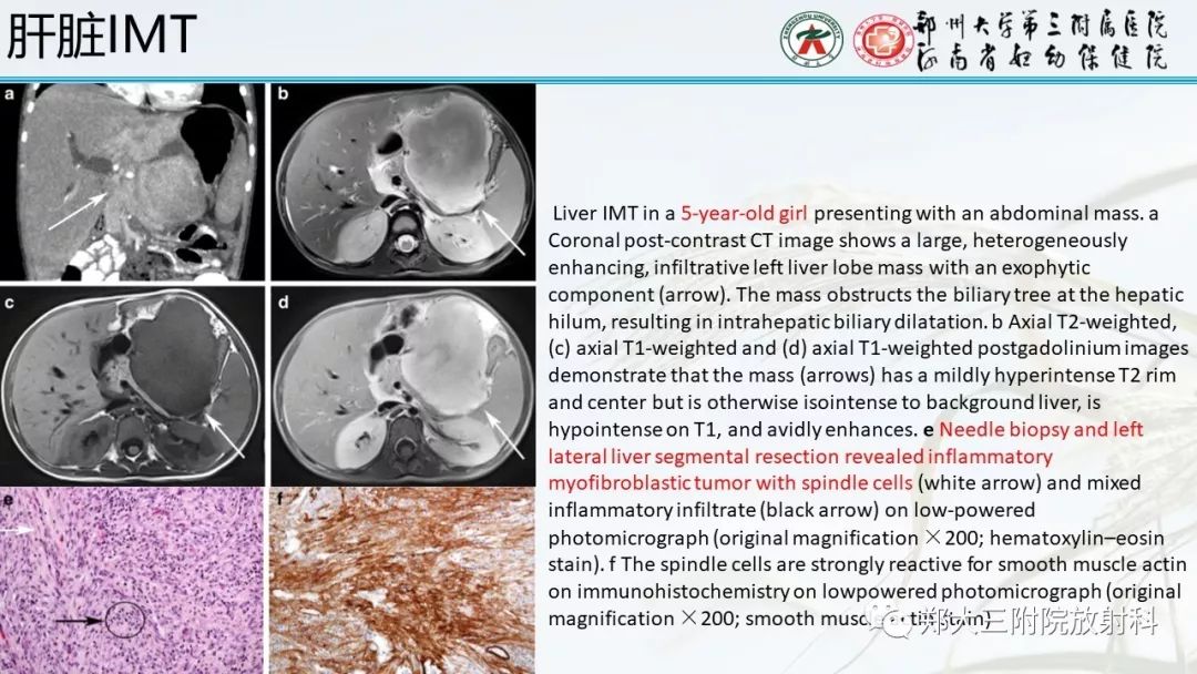 【PPT】炎性肌纤维母细胞瘤的影像表现