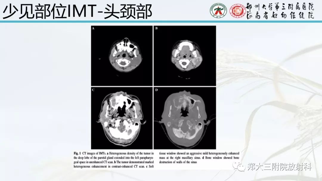 【PPT】炎性肌纤维母细胞瘤的影像表现
