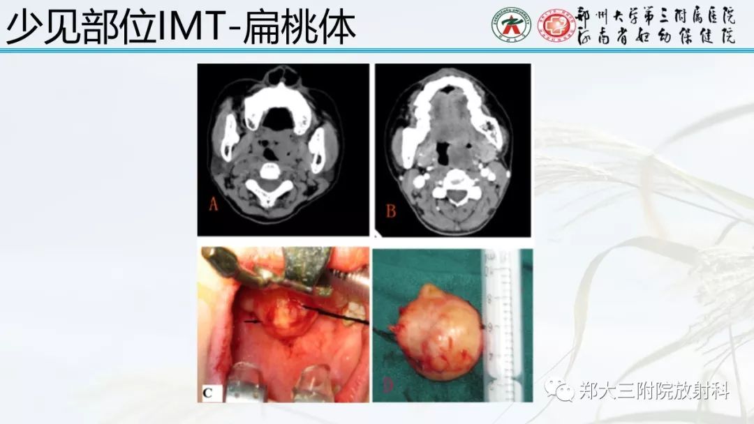 【PPT】炎性肌纤维母细胞瘤的影像表现