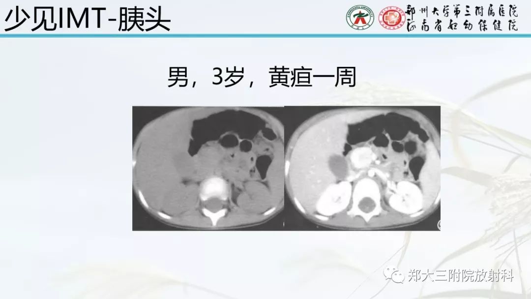 【PPT】炎性肌纤维母细胞瘤的影像表现