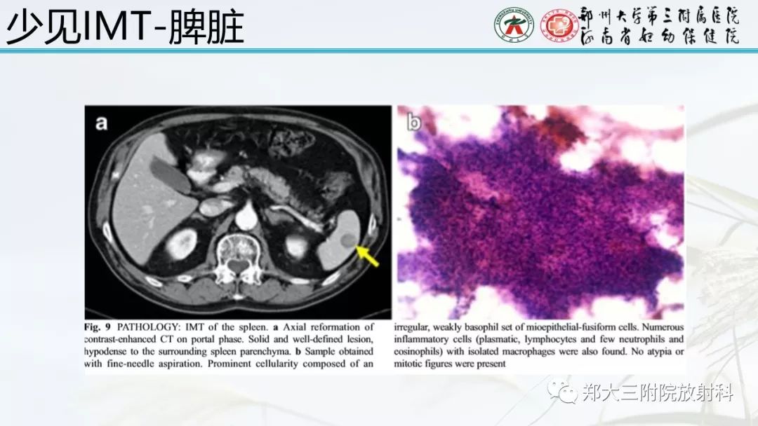 【PPT】炎性肌纤维母细胞瘤的影像表现