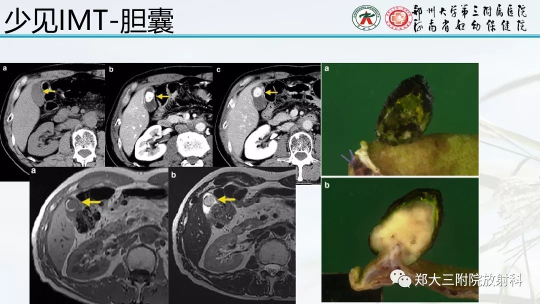 【PPT】炎性肌纤维母细胞瘤的影像表现