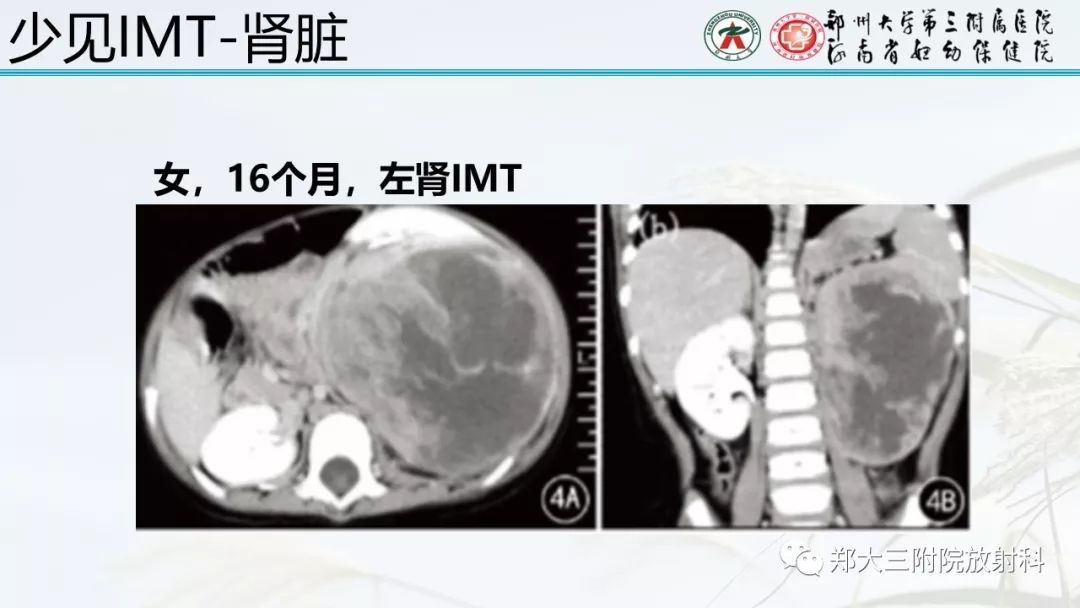 【PPT】炎性肌纤维母细胞瘤的影像表现