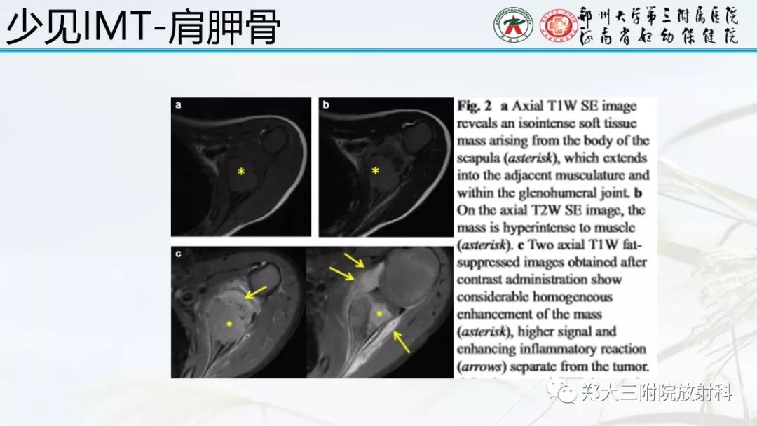 【PPT】炎性肌纤维母细胞瘤的影像表现