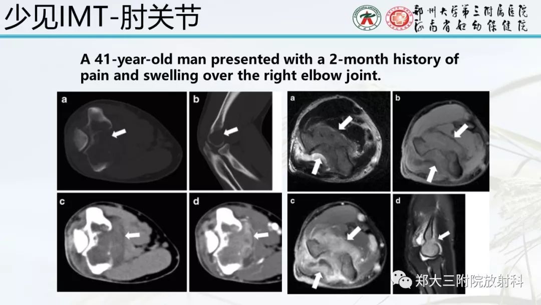 【PPT】炎性肌纤维母细胞瘤的影像表现