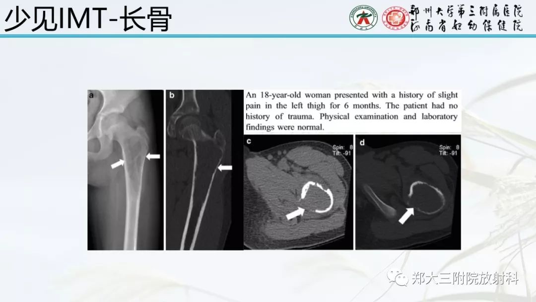 【PPT】炎性肌纤维母细胞瘤的影像表现