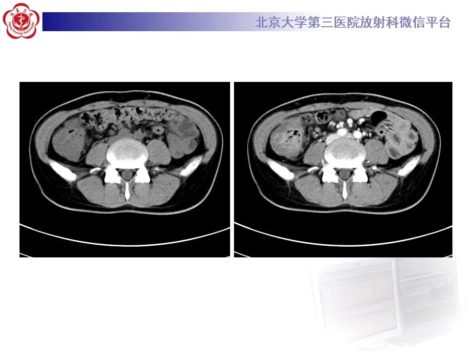 【PPT】炎症性肠病的CT/MR诊断 第四部分：鉴别诊断