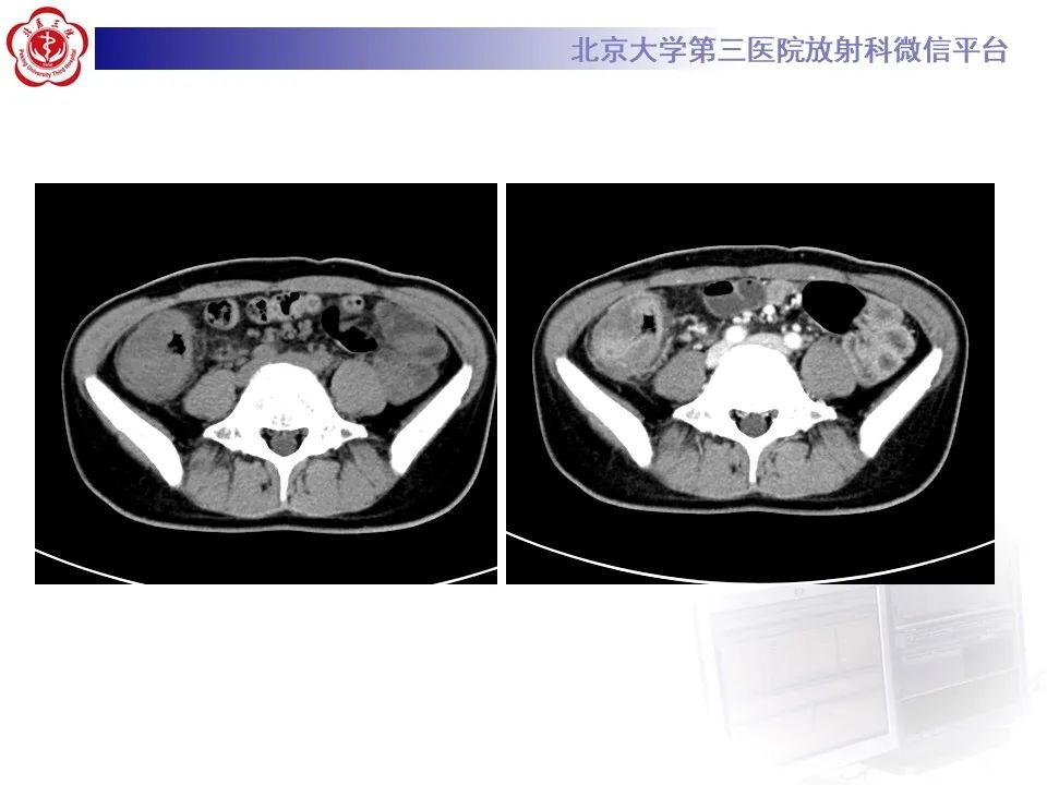 【PPT】炎症性肠病的CT/MR诊断 第四部分：鉴别诊断