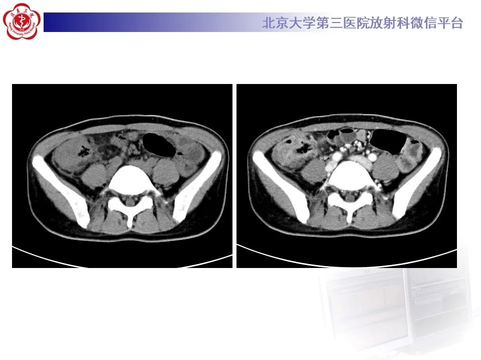 【PPT】炎症性肠病的CT/MR诊断 第四部分：鉴别诊断