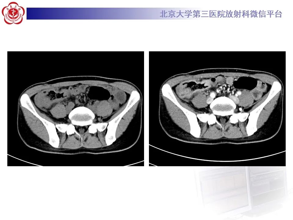 【PPT】炎症性肠病的CT/MR诊断 第四部分：鉴别诊断