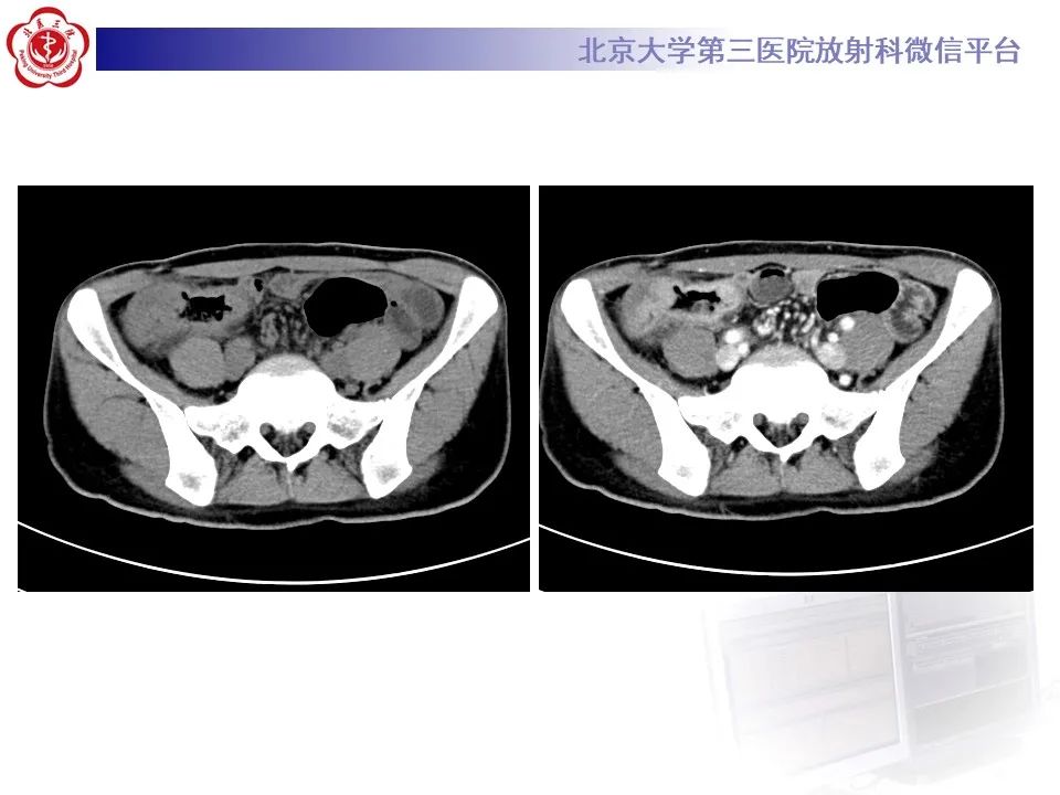 【PPT】炎症性肠病的CT/MR诊断 第四部分：鉴别诊断