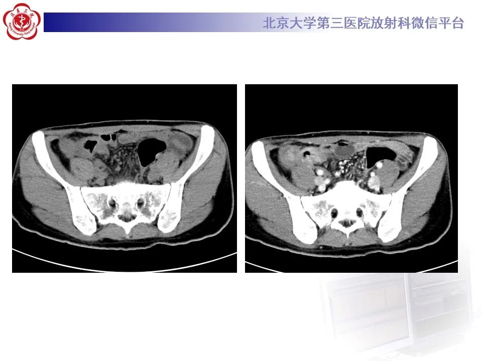 【PPT】炎症性肠病的CT/MR诊断 第四部分：鉴别诊断