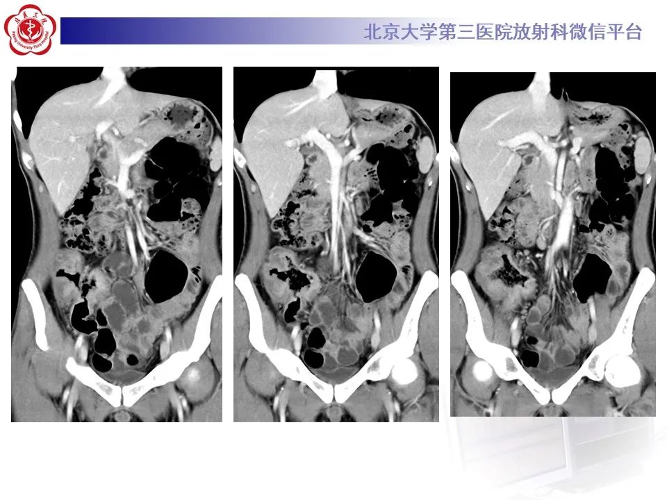 【PPT】炎症性肠病的CT/MR诊断 第四部分：鉴别诊断