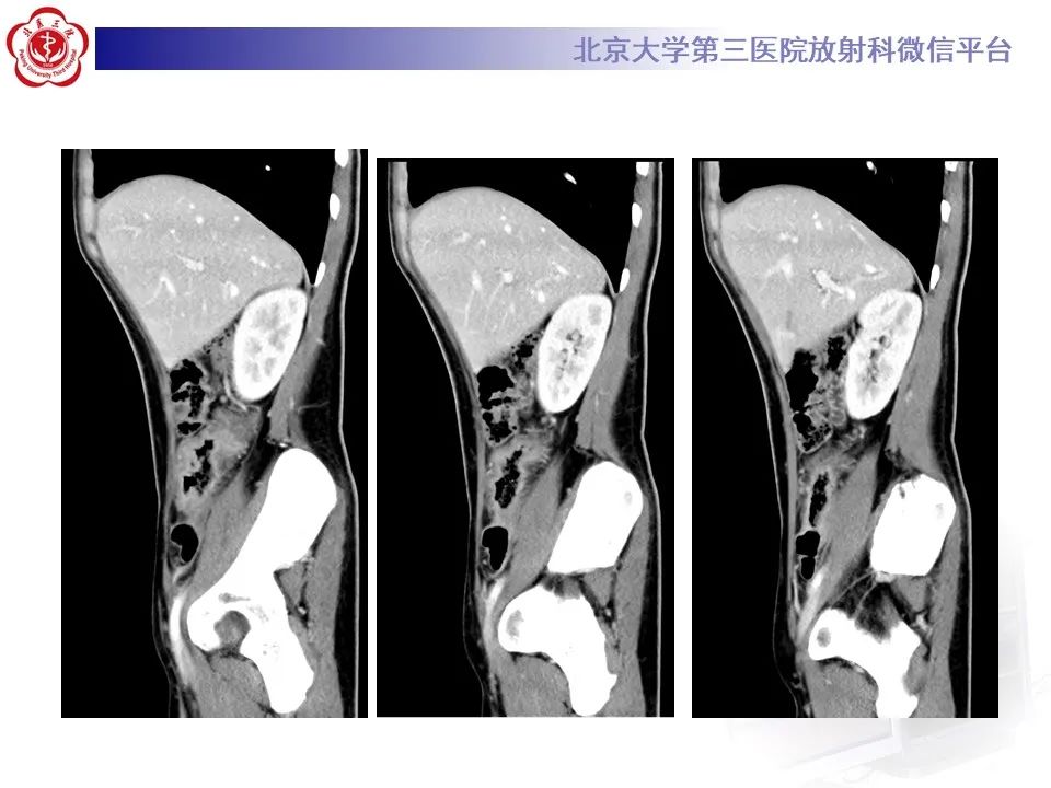 【PPT】炎症性肠病的CT/MR诊断 第四部分：鉴别诊断