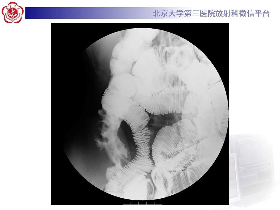 【PPT】炎症性肠病的CT/MR诊断 第四部分：鉴别诊断
