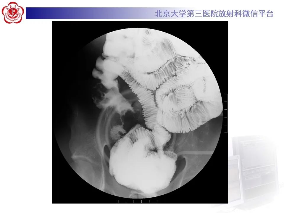 【PPT】炎症性肠病的CT/MR诊断 第四部分：鉴别诊断