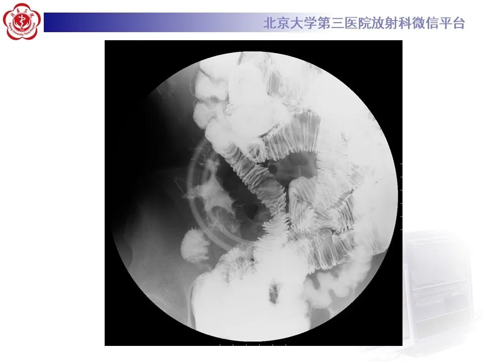 【PPT】炎症性肠病的CT/MR诊断 第四部分：鉴别诊断