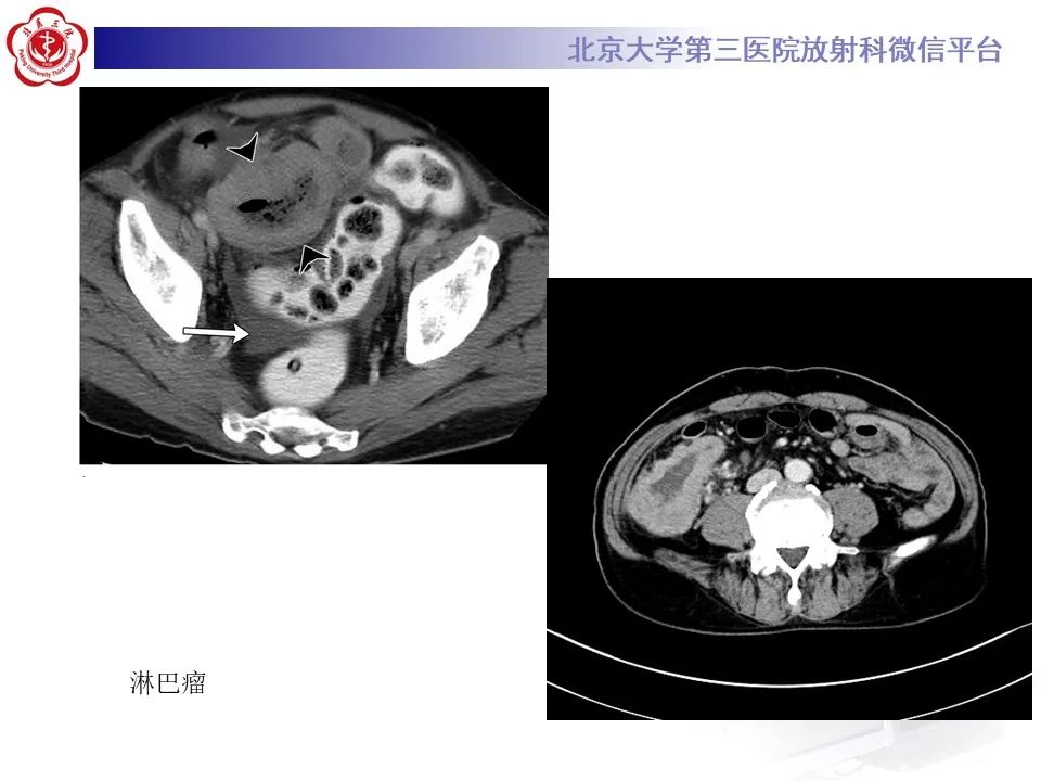 【PPT】炎症性肠病的CT/MR诊断 第四部分：鉴别诊断