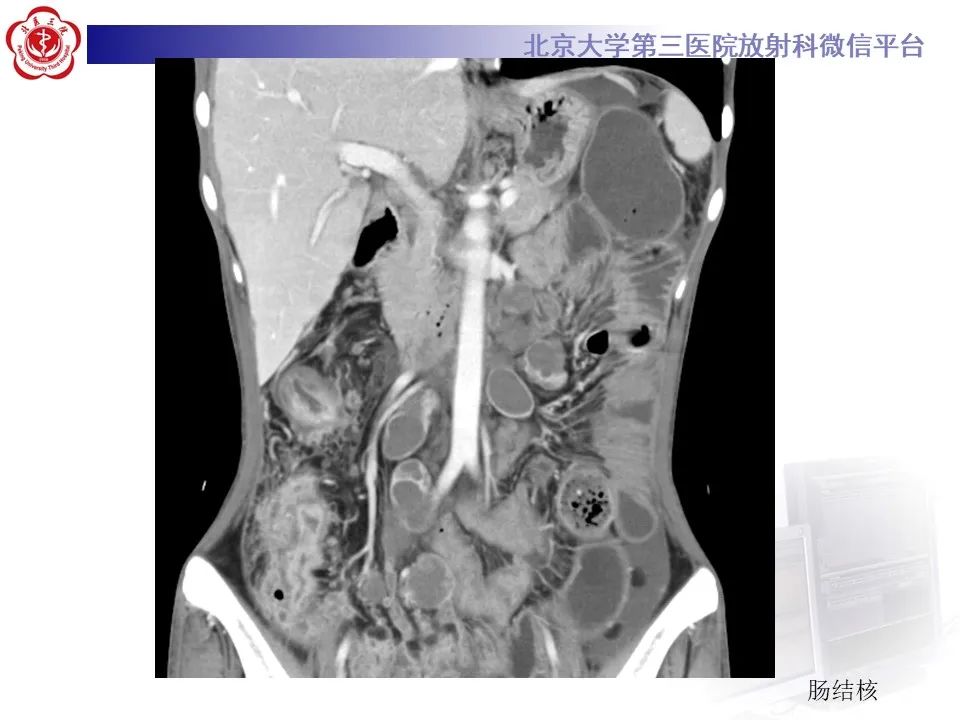 【PPT】炎症性肠病的CT/MR诊断 第四部分：鉴别诊断