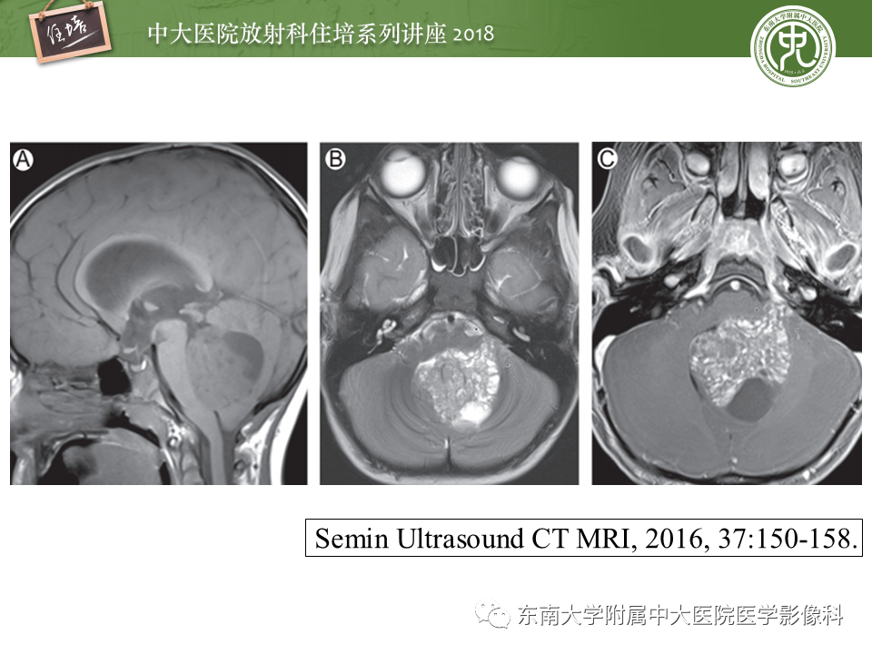 【PPT】脑室内肿瘤的影像学表现及鉴别