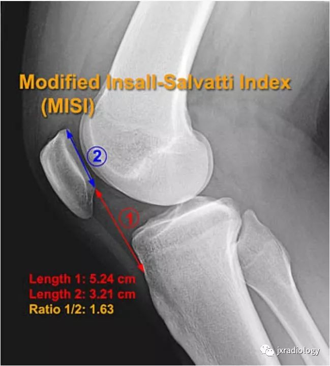 高位/低位髌骨(Patella Alta and Baja) 高位/低位髌骨(Patella Alta and Baja)