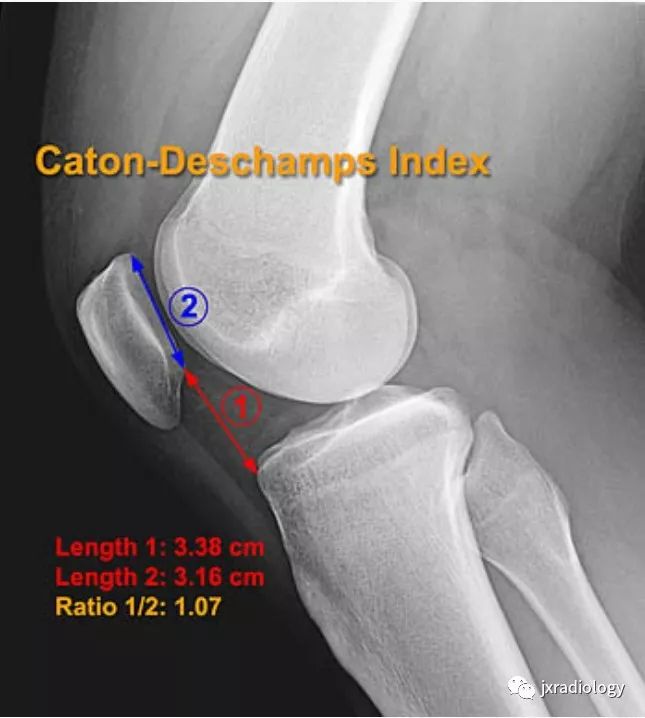 高位/低位髌骨(Patella Alta and Baja) 高位/低位髌骨(Patella Alta and Baja)