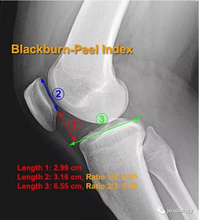 高位/低位髌骨(Patella Alta and Baja) 高位/低位髌骨(Patella Alta and Baja)