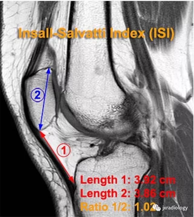 高位/低位髌骨(Patella Alta and Baja) 高位/低位髌骨(Patella Alta and Baja)