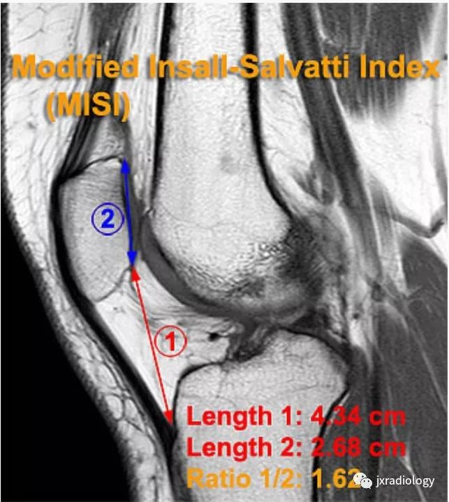高位/低位髌骨(Patella Alta and Baja) 高位/低位髌骨(Patella Alta and Baja)