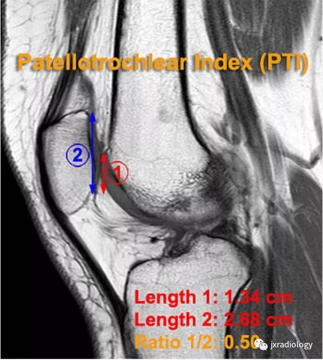 高位/低位髌骨(Patella Alta and Baja) 高位/低位髌骨(Patella Alta and Baja)